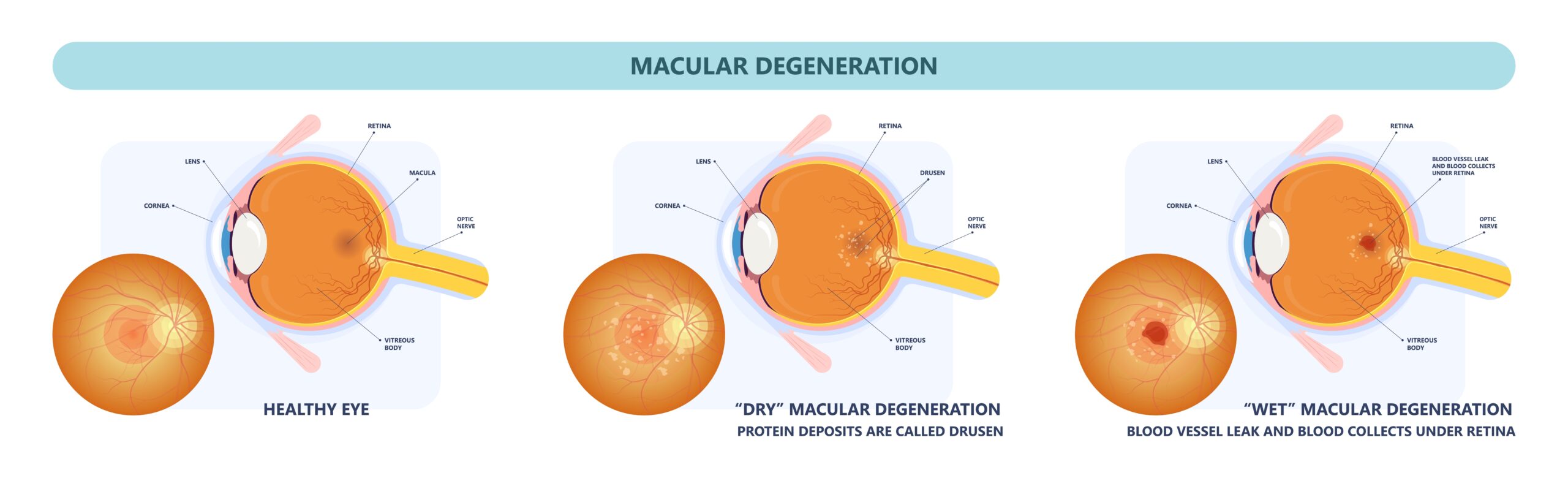 Macular Degeneration Orlando