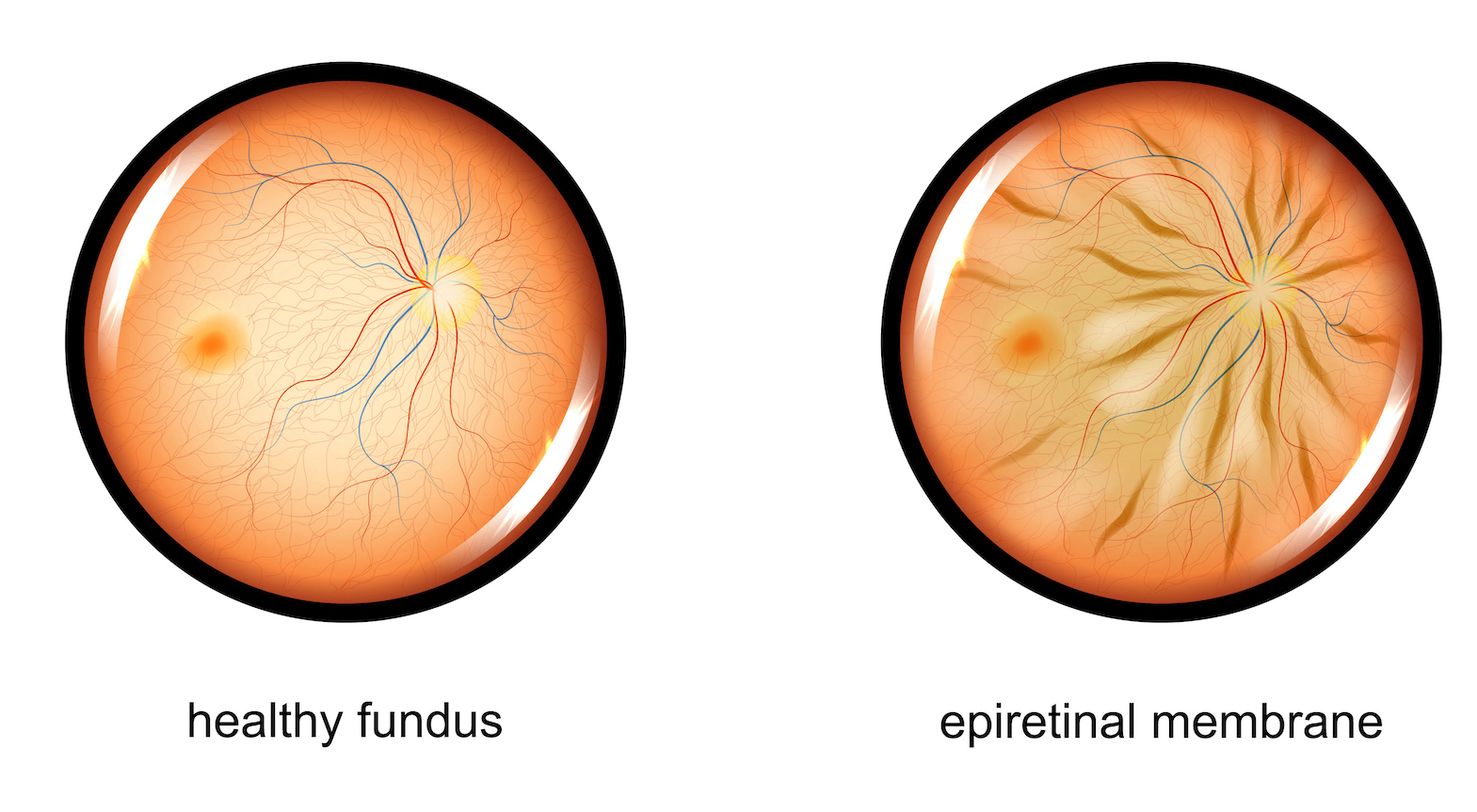 Macular pucker retina consultants of orlando