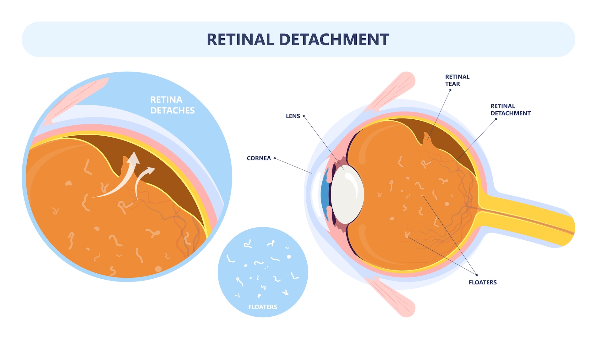 Retinal Detachment Orlando Retina Consultants of Orlando